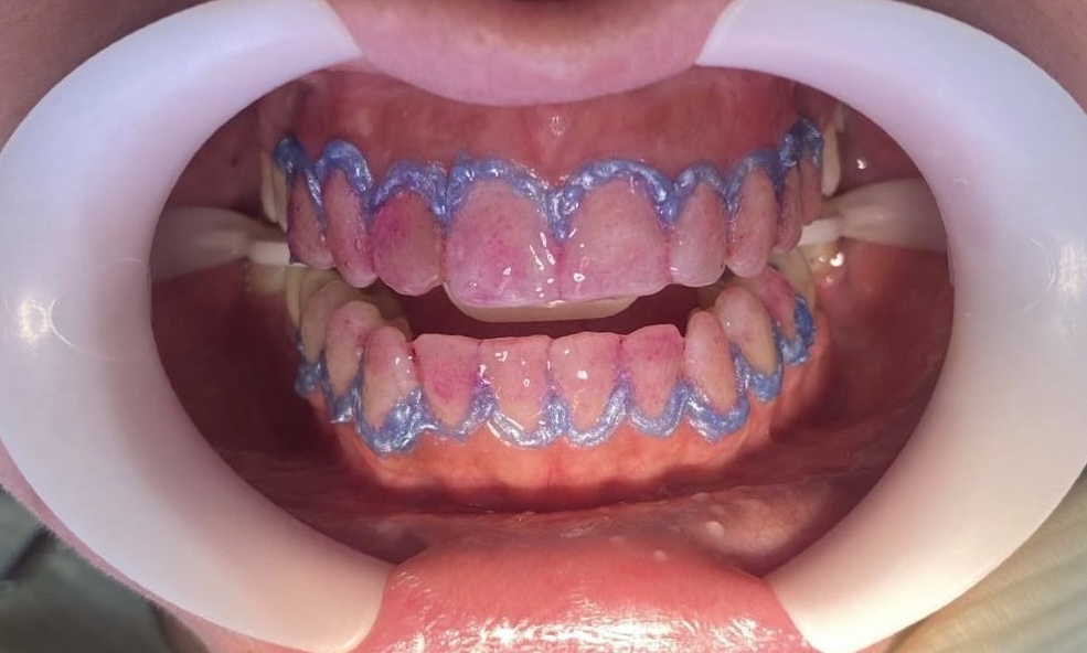 Clareamento Clareamento dental