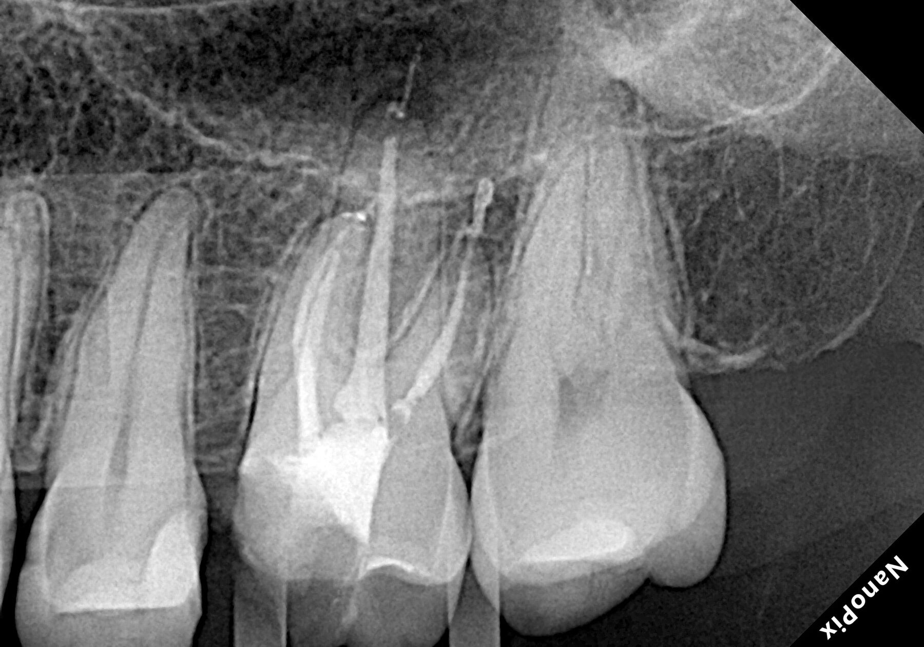 Endo Radiografia final