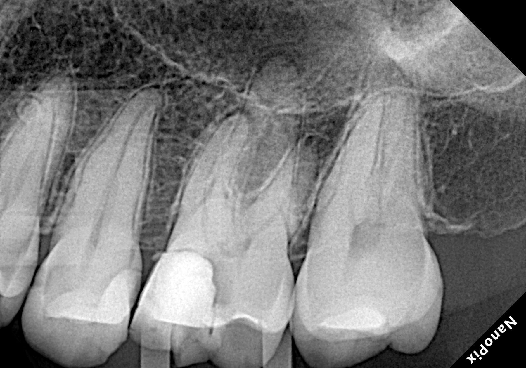 Endo Radiografia inicial